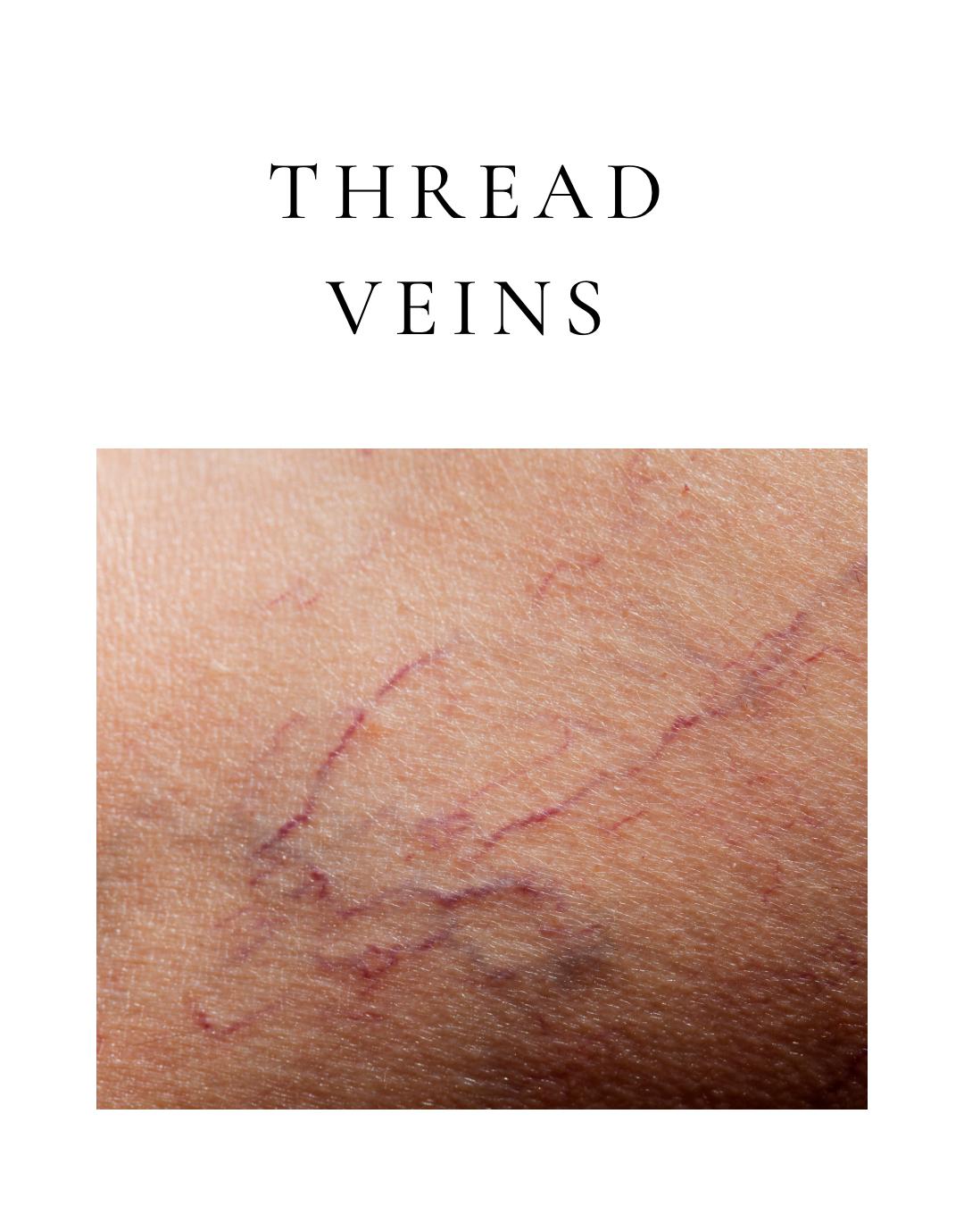 Thread Veins